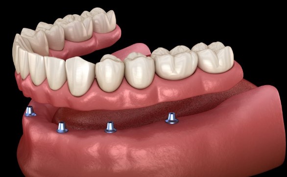 How Dentures Can Restore Your Self-Esteem